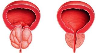 the difference of patients and healthy prostate