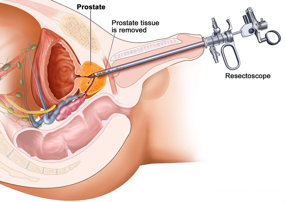 Taking prostate tissue for accurate diagnosis of prostatitis